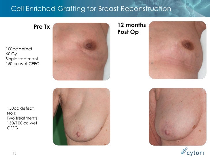 fat grafting with breast reconstruction Muscular lady fucked